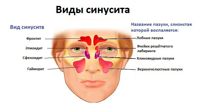Виды синусита
