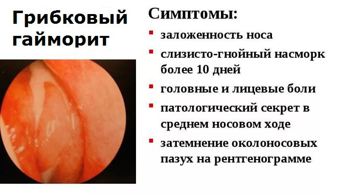 Грибковый гайморит 