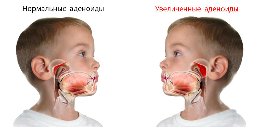 Воспаление аденоидов