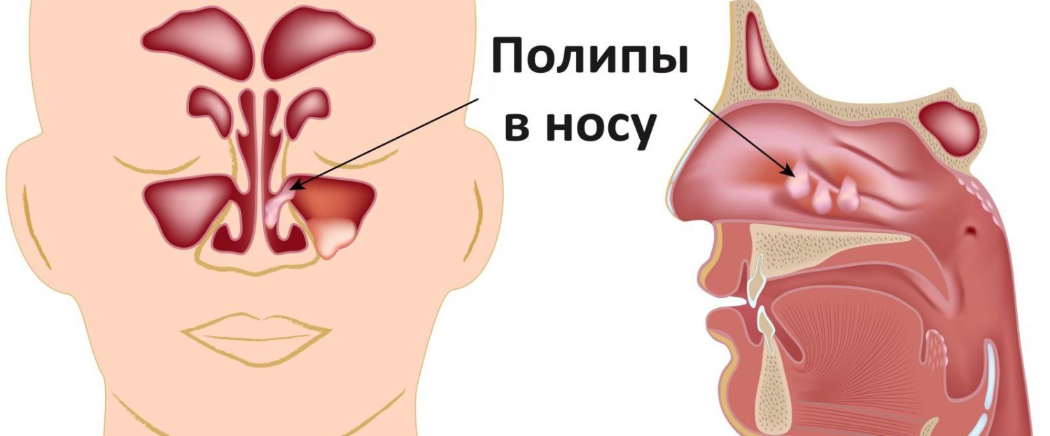 Полипы в носу