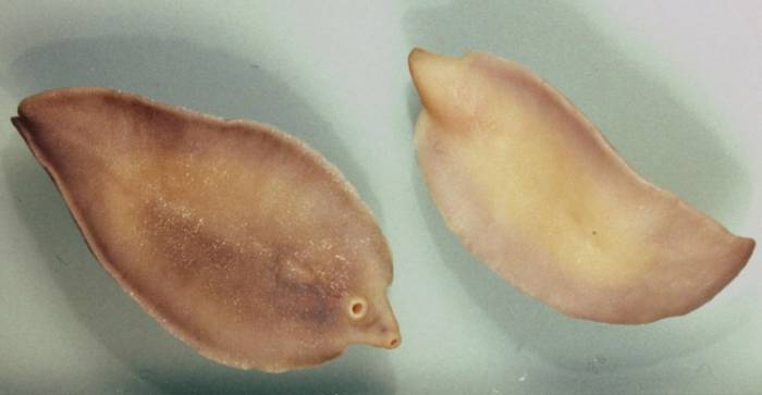 Хроническая стадия фасциолеза