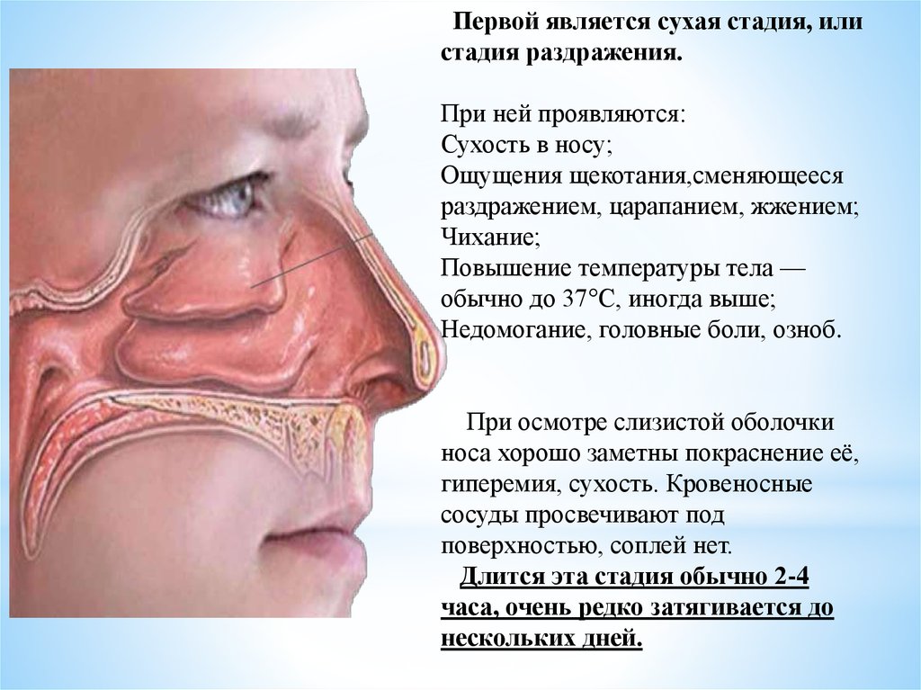 Острый ринит 