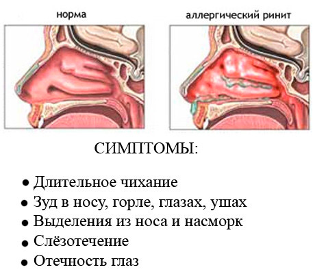 Аллергический ринит