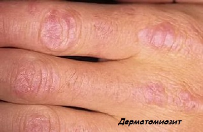 Дерматомиозит