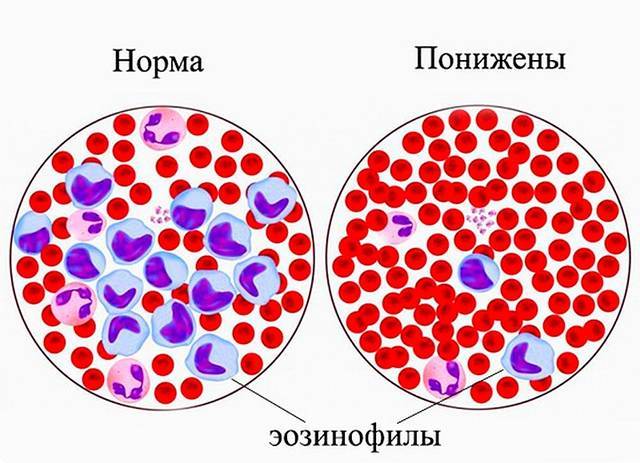 Понижены эозинофилы у ребенка, что это значит?