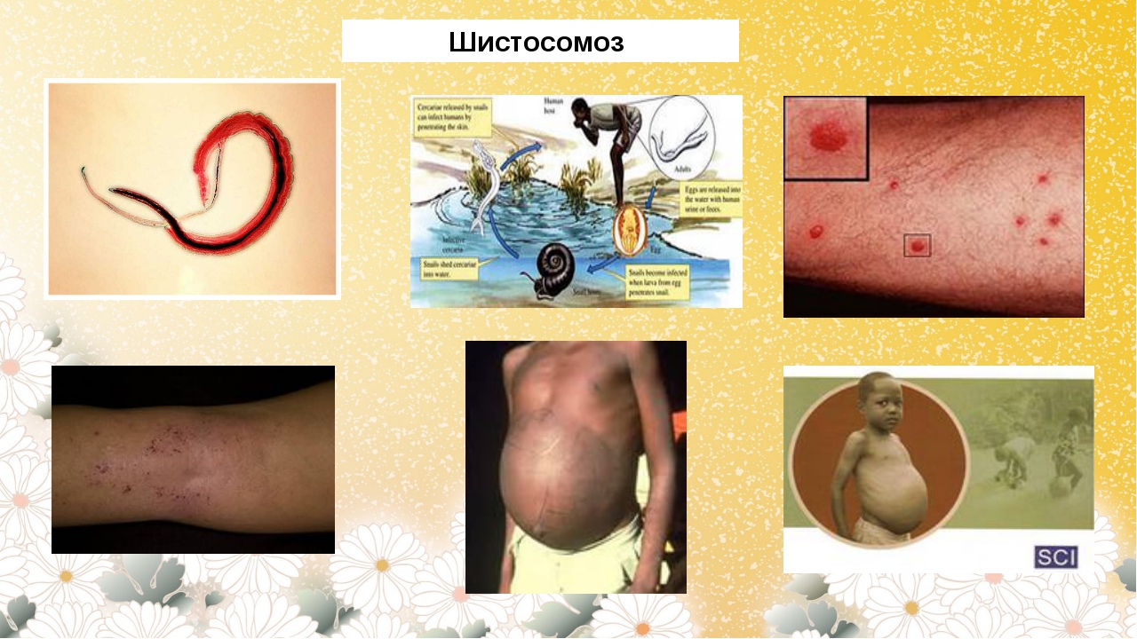 Шистосомоз