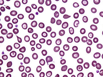 talassemia