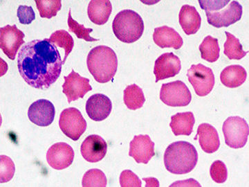 anemia