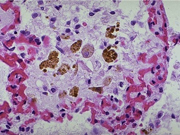 ferritin (4)