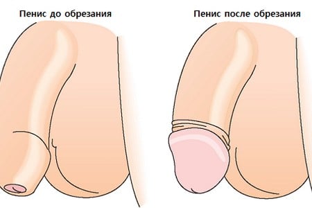 До и после обрезания