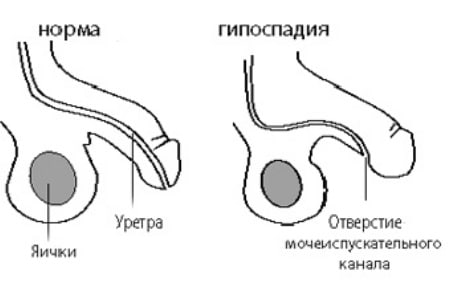 гипоспадия