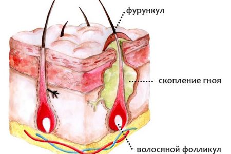 структура фурункула