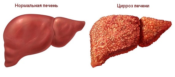 здоровая и больная печень