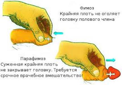 парафимоз