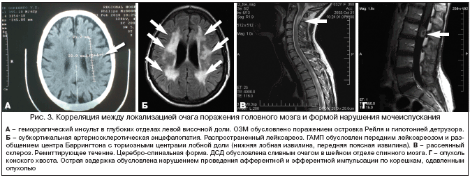 Рис. 3. Корреляция между локализацией очага поражения головного мозга и формой нарушения мочеиспускания