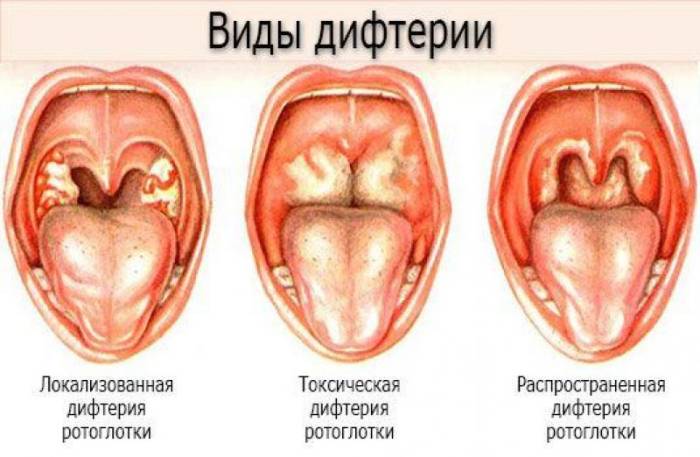 Дифтерия - симптомы и лечение у детей и взрослых