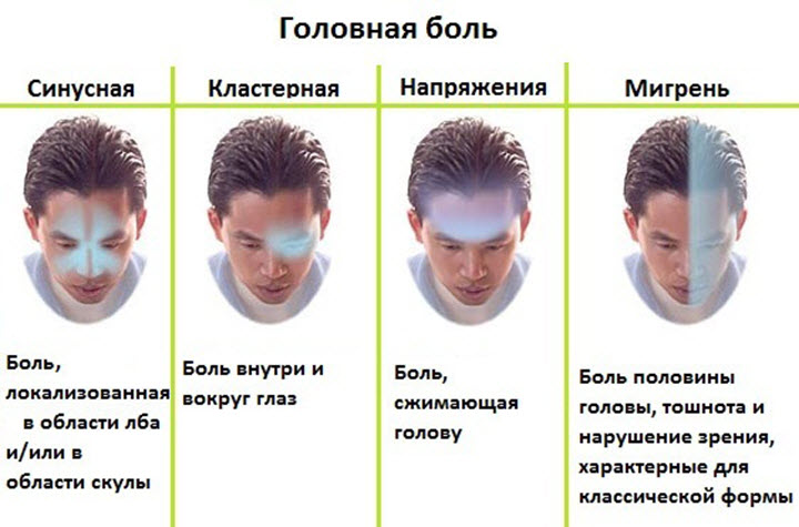 Виды головных болей