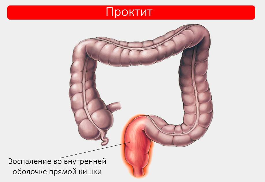 Проктит. Причины, симптомы и лечение проктита.