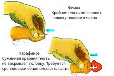 затруднение в закрытие головки