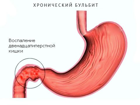 Бульбит. Симптомы, диета и лечение бульбита двенадцатиперстной кишки.