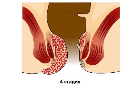 4-стадия геморроя