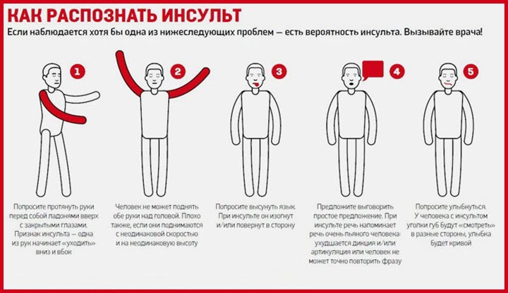 Признаки инсульта
