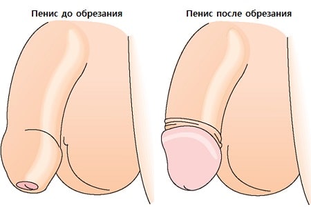 Обрезания