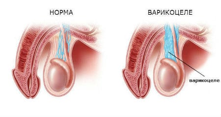 варикоцеле