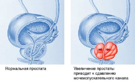 простатит