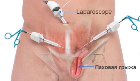 Паховая грыжа