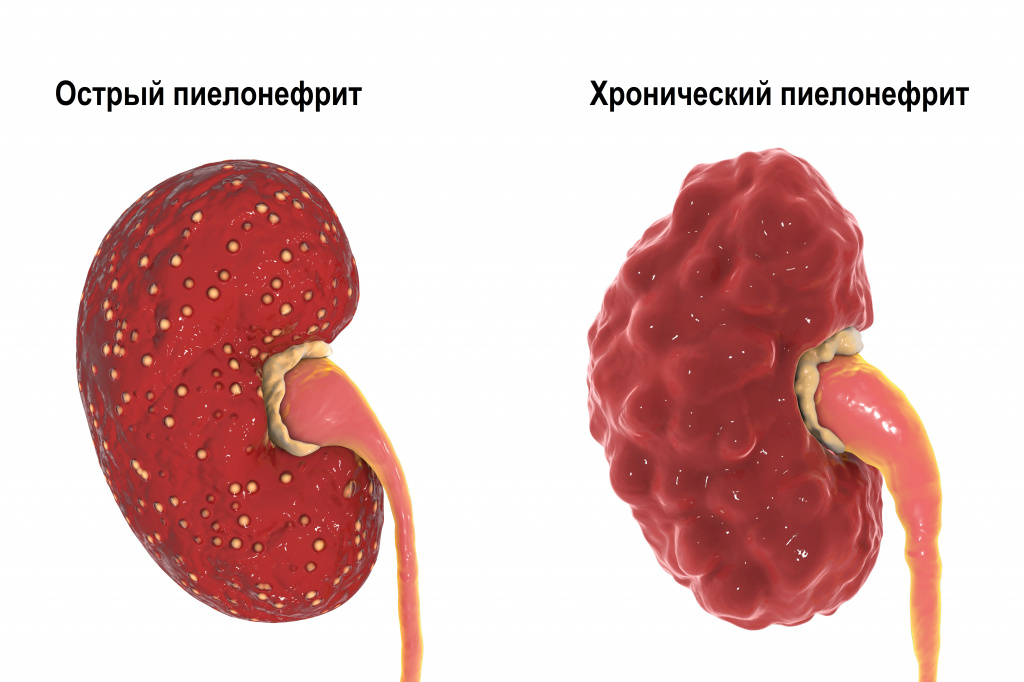 Острый пиелонефрит. Симптомы и лечение острого пиелонефрита.