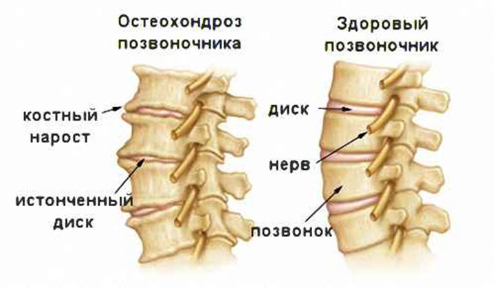 Остеоханроз как одна из причин