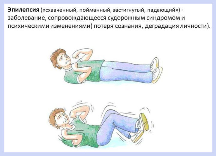 Проявления эпилептического припадка