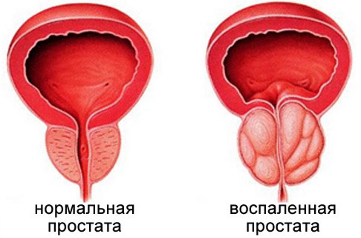 Хронический простатит