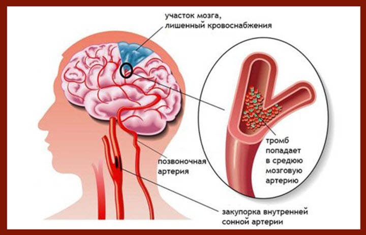 Нарушение кровоснабжения мозга