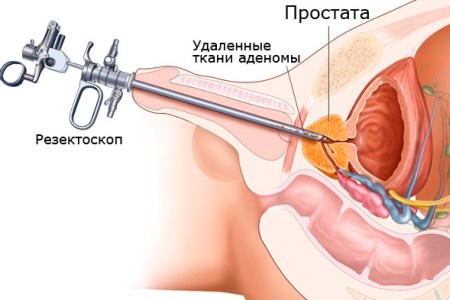 трансуретральная резекция аденомы простаты