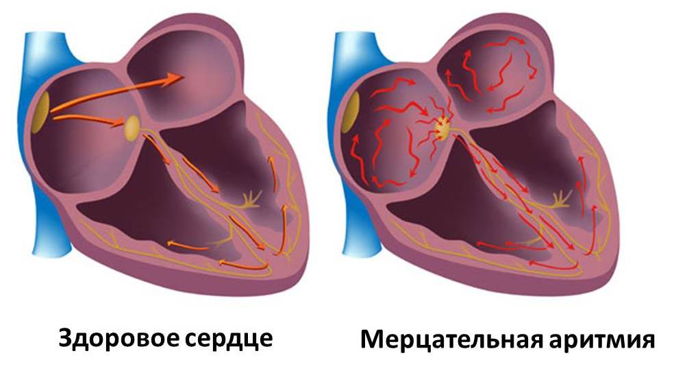 Мерцательная аритмия. Симптомы, причины и лечение