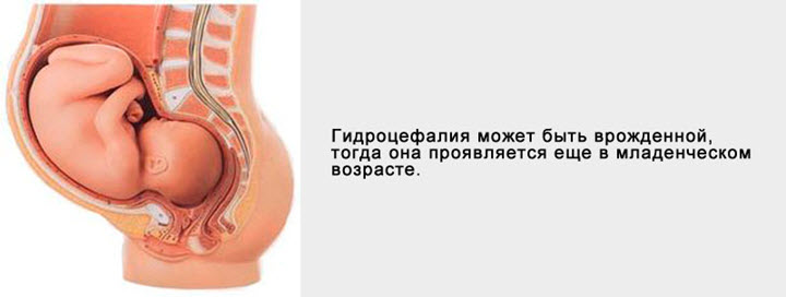 Причины внутриутробной гидроцефалии
