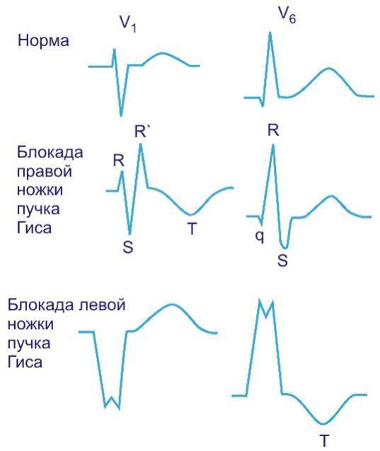 Блокада ножек пучка Гиса: правая, левая, полная и неполная