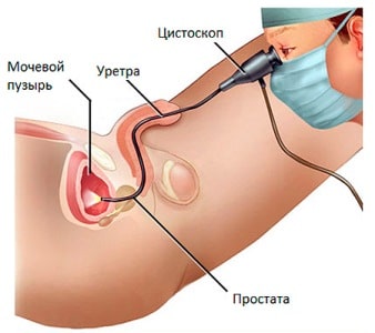 цистоскопия мочевого пузыря
