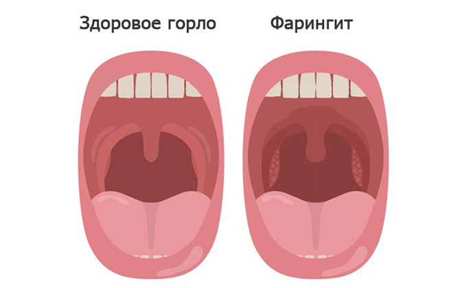 Фарингит. Симптомы и лечение фарингита у детей и взрослых с фото.