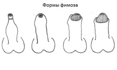 фимоз