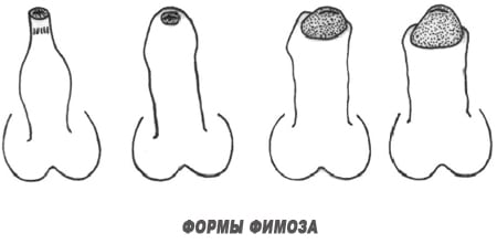 формы фимоза препуций 