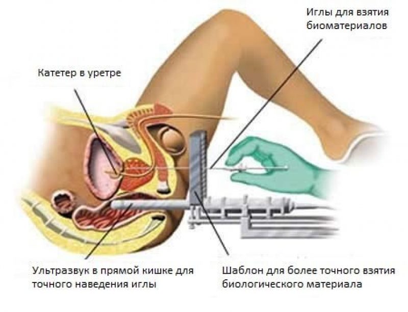 Фьюжн биопсия простаты