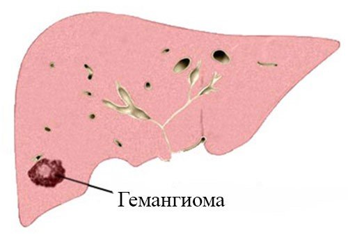 Гемангиома печени. Причины и лечение гемангиомы печени.