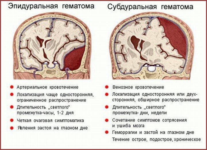 Виды гематом ГМ