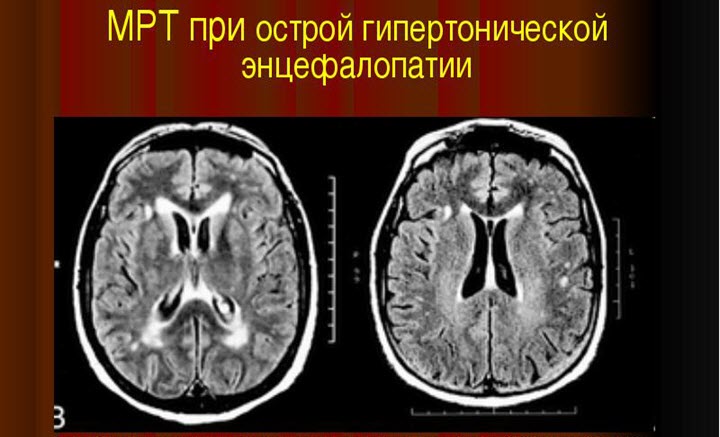 Цереброваскулярная энцефалопатия