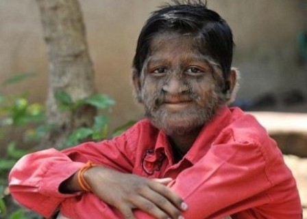 гипертрихоз у мальчика гипертрихоз у мальчика