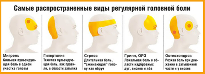 Виды головных болей
