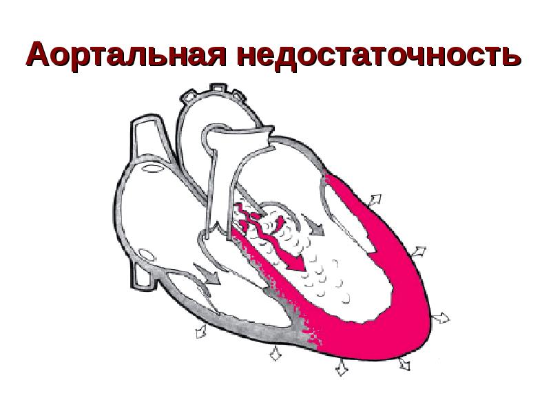 Аортальная недостаточность. Степени, прогноз и лечение